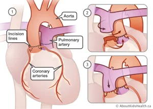 Phẫu thuật đảo gốc động mạch