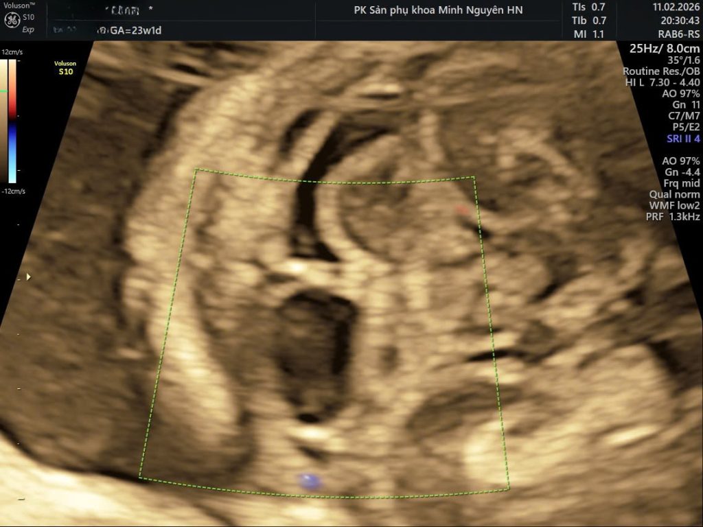 Siêu âm nang màng nhện hố sau