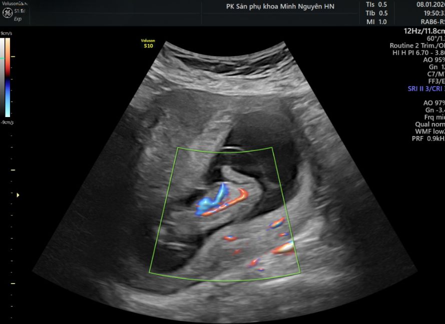 Dây rốn một động mạch