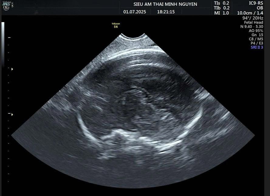 bất sản thể chai là gì