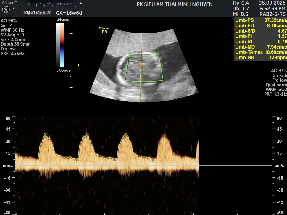 hình ảnh siêu âm tăng vận tốc đỉnh tâm trương động mạch não giữa