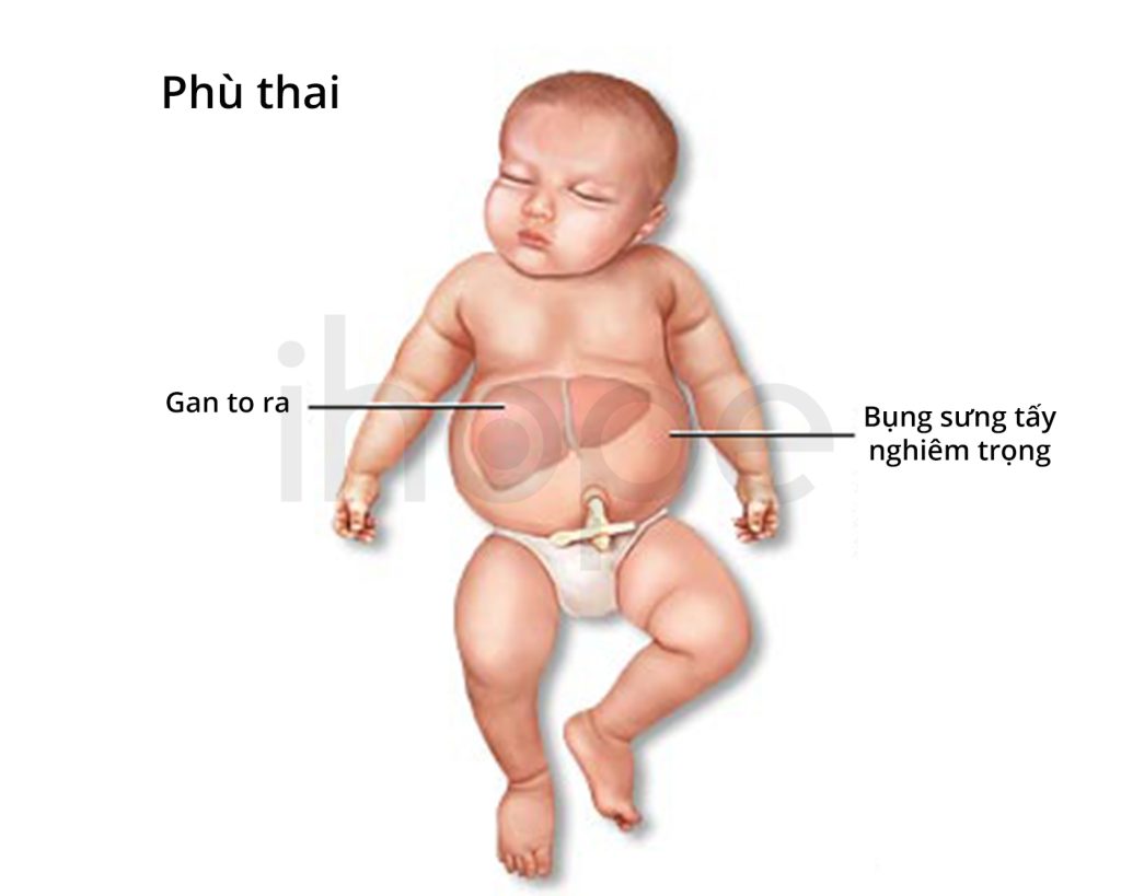 phù thai