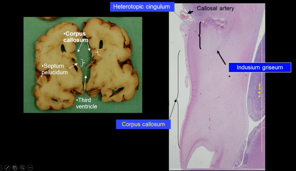 bất sản thể chai là gì