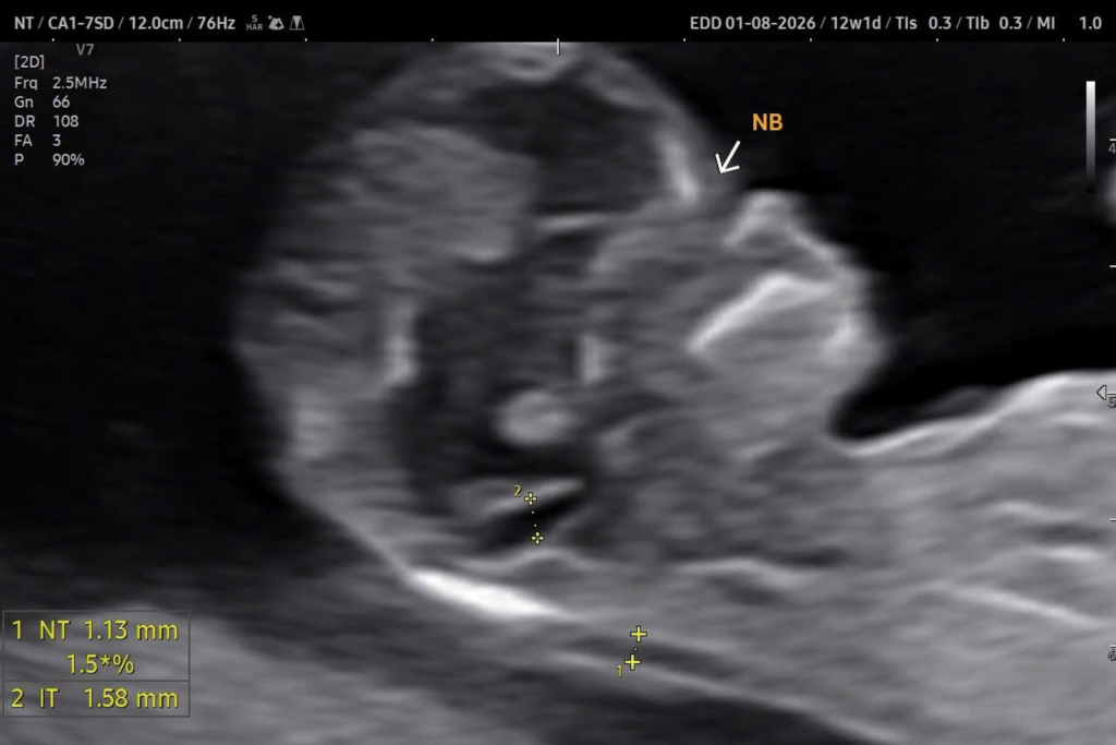 bất sản xương mũi là gì