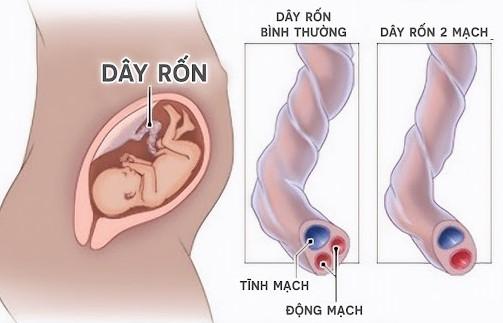 Dây rốn bình thường và dây rốn một động mạch