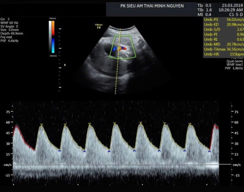 Hình ảnh Doppler trong siêu âm thai chậm tăng trưởng