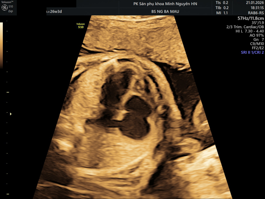 bệnh Ebstein là gì