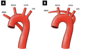 giải phẫu động mạch dưới đòn phải lạc chỗ