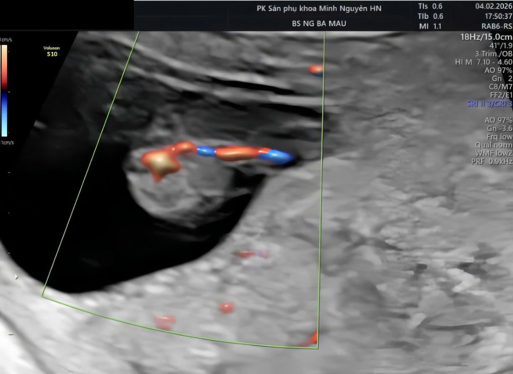 Dây rốn một động mạch