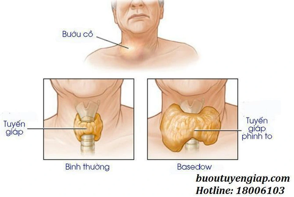 Cường giáp Basedow có nguy hiểm không?