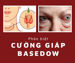 Cường giáp Basedow có nguy hiểm không?
