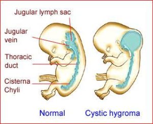 Hình ảnh nang bạch huyết ở cổ
