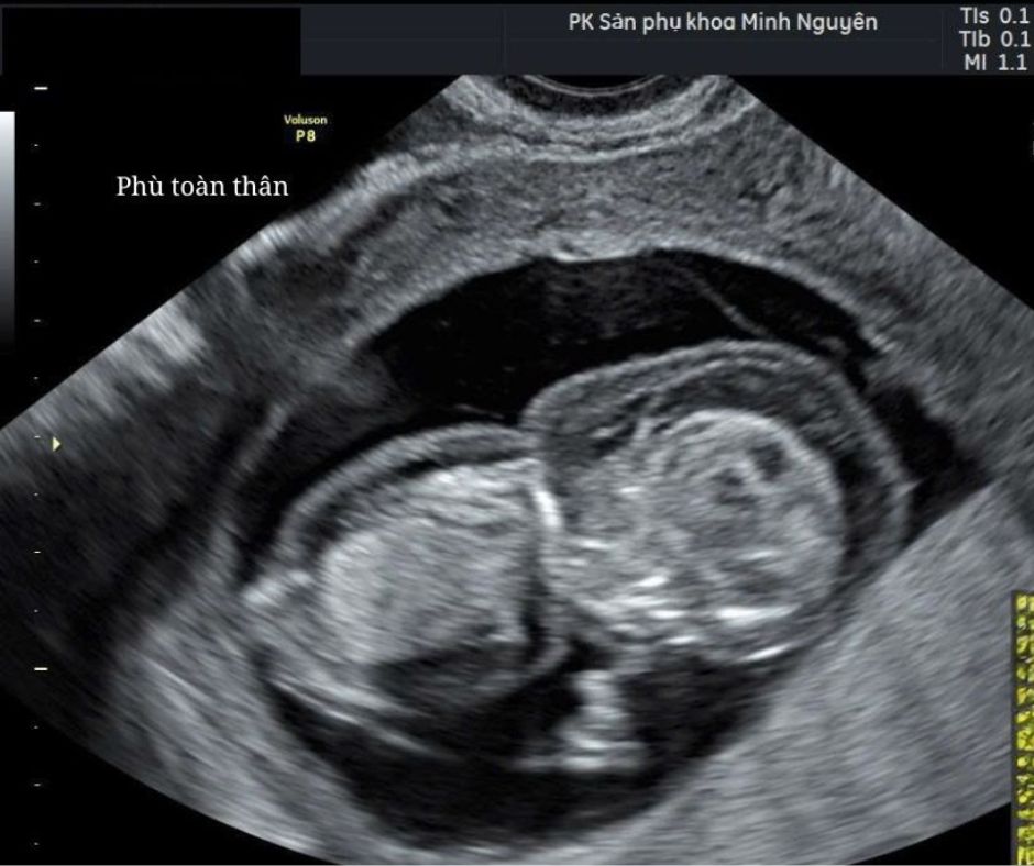Phù thai trên siêu âm