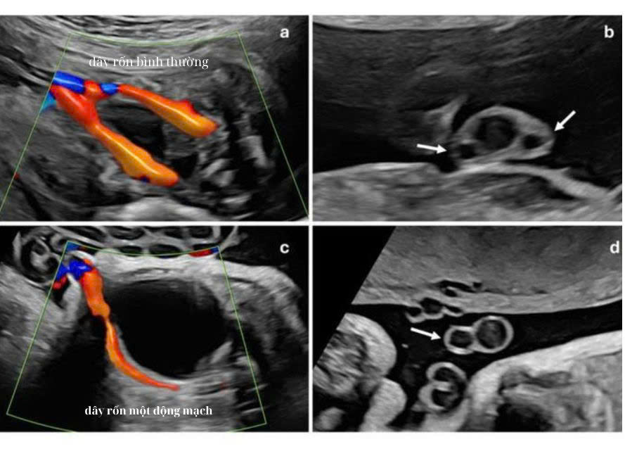 Dây rốn bình thường và dây rốn một động mạch