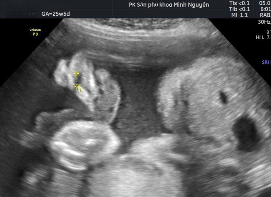 Hình ảnh sứt môi trên siêu âm