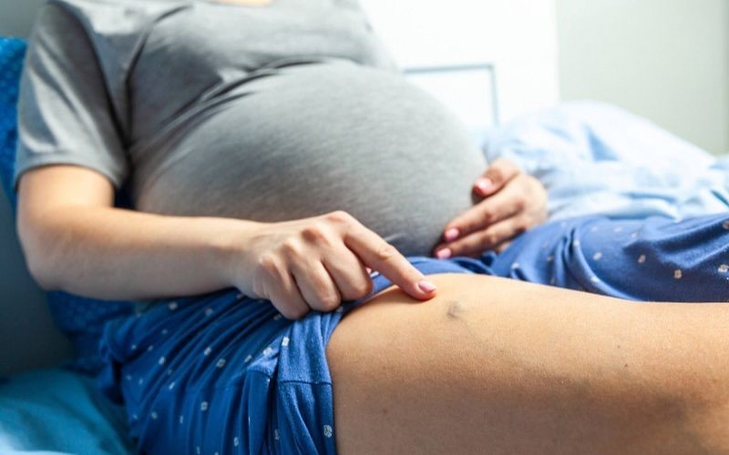 Giãn tĩnh mạch mạng nhện khi mang thai