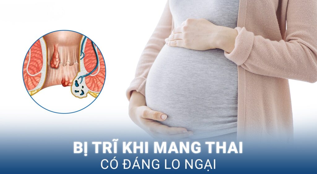 Trĩ khi mang thai