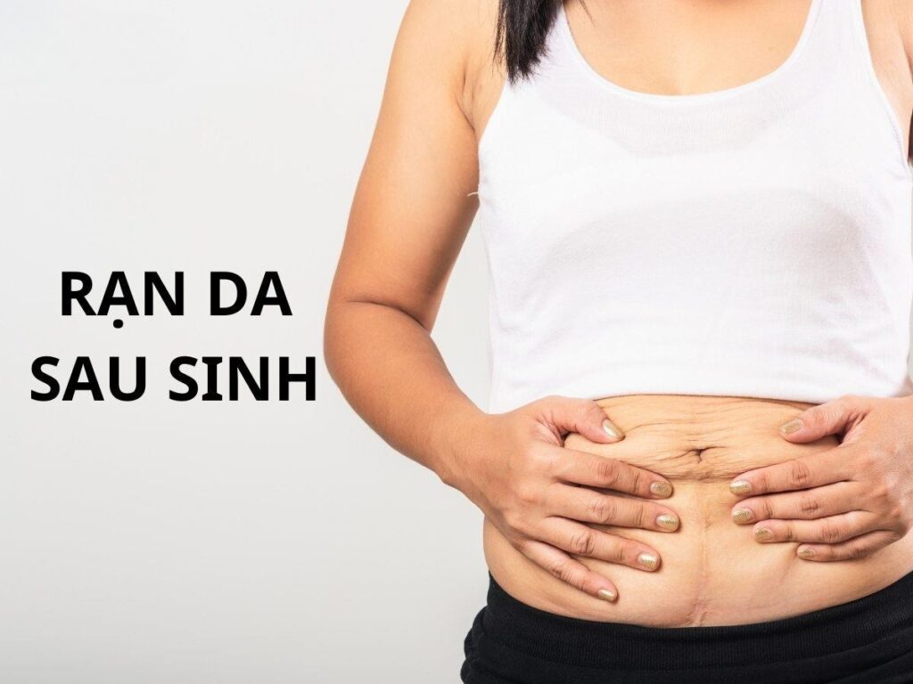 rạn da sau sinh