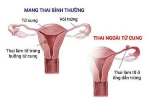 Thai ngoài tử cung thử que có lên 2 vạch không
