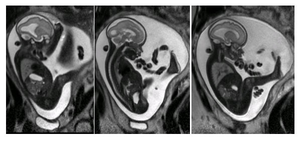 MRI thai