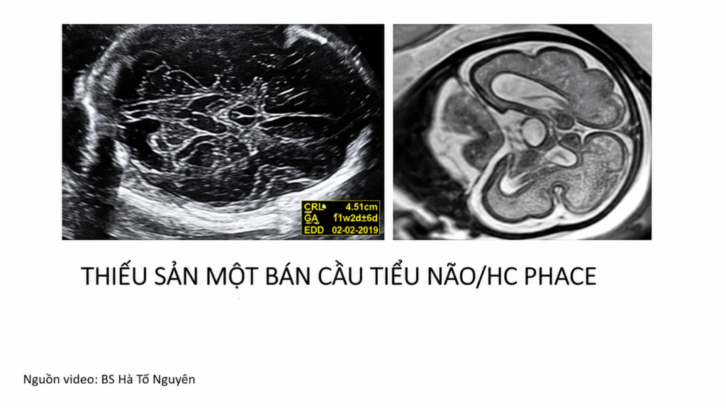 Thiểu sản tiểu não