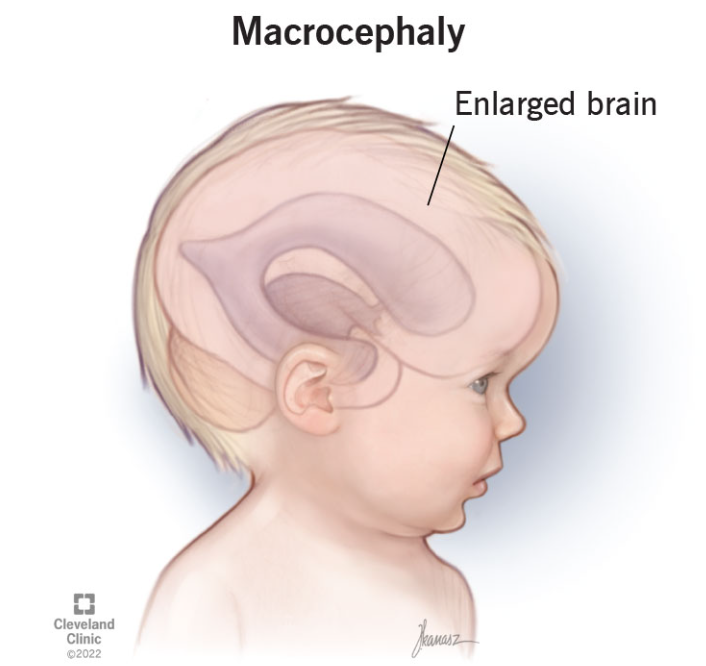Đầu to macrocephaly