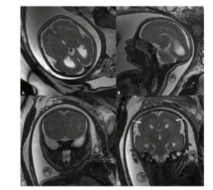 mri thai trong bất thường vỏ não thai nhi