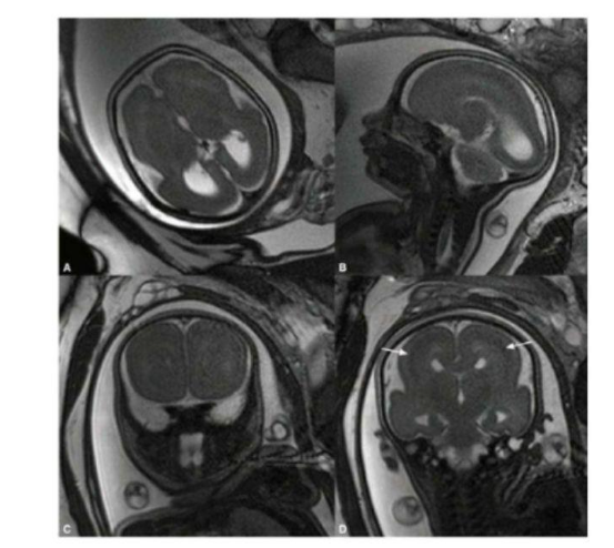 mri thai trong bất thường vỏ não thai nhi