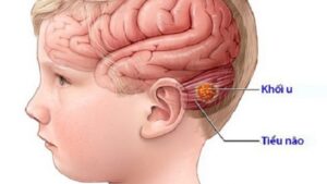 phì đại bán cầu não thai nhi