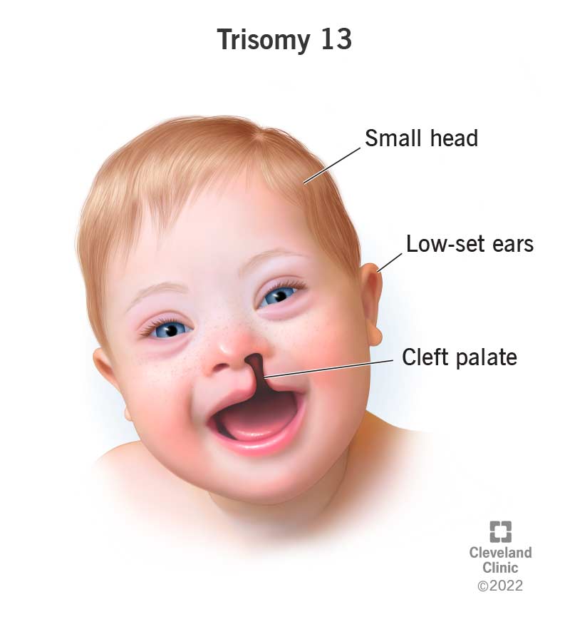 Bất sản thể chai có liên quan trisomy 13 và 18 hay không Khi nào cần nghĩ đến lệch bội