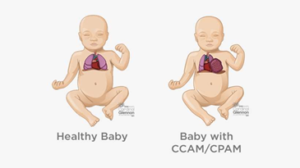CPAM có làm chèn ép tim và lệch trung thất không