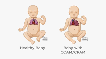 CPAM có làm chèn ép tim và lệch trung thất không