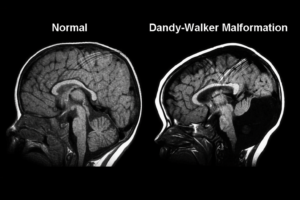 Dị dạng Dandy-Walker