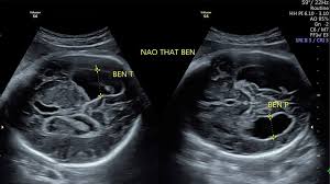 Giãn não thất đơn độc và không đơn độc khác nhau thế nào