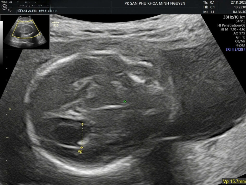 dị dạng vỏ não và giãn não thất