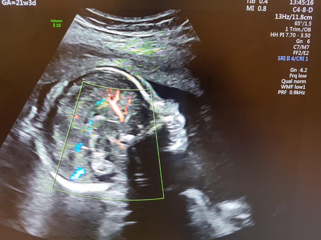 Khi nào cần MRI thai trong bất thường thể chai