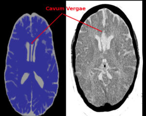 Không thấy cavum septi pellucidi có luôn là bất sản thể chai không