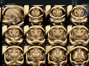 MRI giúp phát hiện gì thêm trong bất thường thể chai