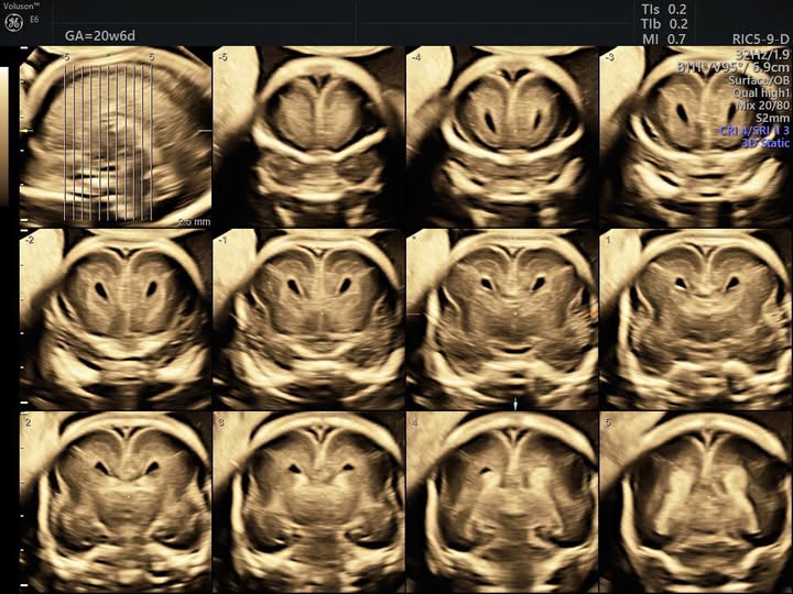MRI giúp phát hiện gì thêm trong bất thường thể chai