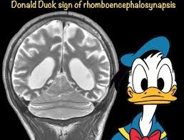 Rhombencephalosynapsis