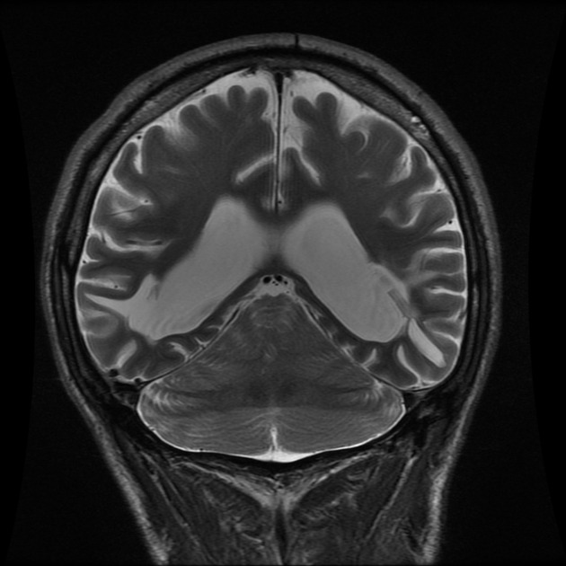 Rhombencephalosynapsis
