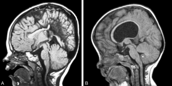 Rhombencephalosynapsis
