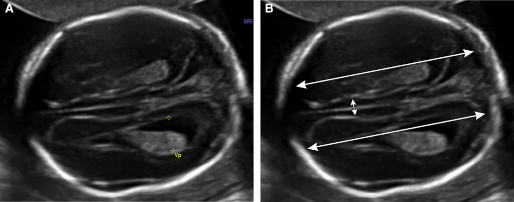 Tear-drop ventricles là gì trong bất sản thể chai