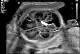 Thùy nhộng tiểu não thai nhi