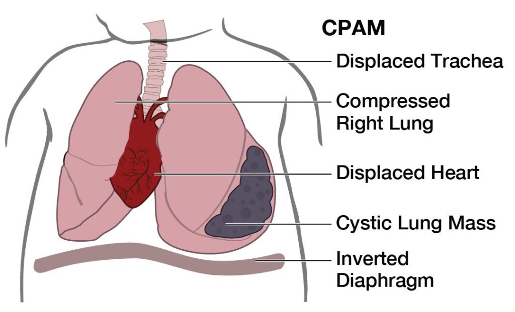 Tiên lượng của CPAM phụ thuộc vào những yếu tố nào
