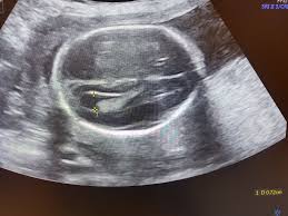 Trẻ sau sinh bị bất sản thể chai cần theo dõi gì