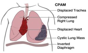 Hình minh họa CPAM ở thai nhi với khối nang phổi gây chèn ép phổi, đẩy lệch tim và khí quản