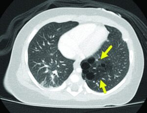 Hình ảnh CT lồng ngực cho thấy CPAM với nhiều nang khí tập trung tại thùy phổi, gợi ý tổn thương dạng nang điển hình