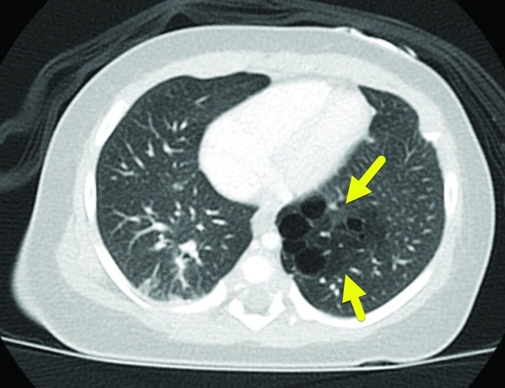 Hình ảnh CT lồng ngực cho thấy CPAM với nhiều nang khí tập trung tại thùy phổi, gợi ý tổn thương dạng nang điển hình
