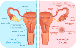 beta hCG thai ngoài tử cung